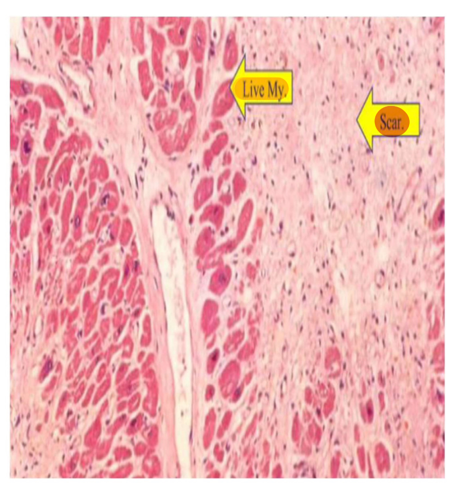 <p><span><span>MI (3-6 weeks: Dense fibrous scar)</span></span></p>